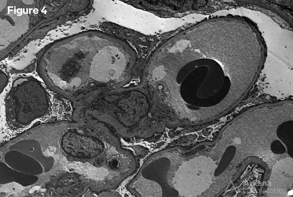 EM imaging of renal biopsy