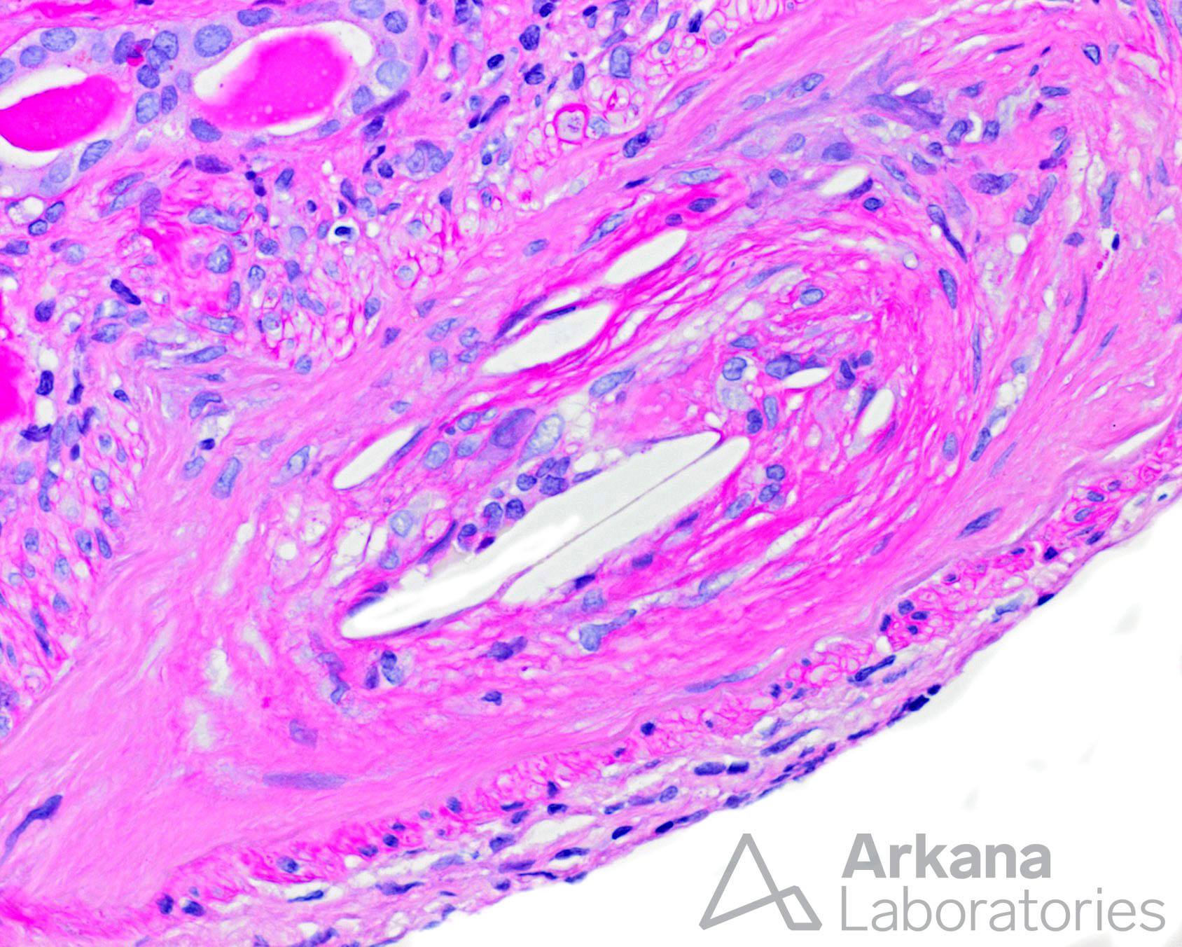 artery with a cholesterol embolus, arkana laboratories, renal pathology, renal disease