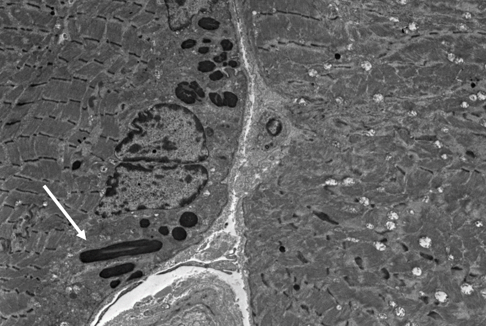 Nemaline Rods, neuro notes, neuropathology, Dr. Mrachek