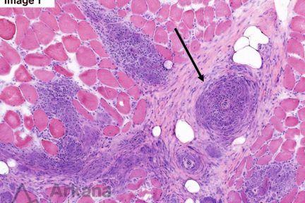 myopathy, Sarcoid Myopathy and Vasculopathy, Neuro Notes, neuropathology, arkana laboratories