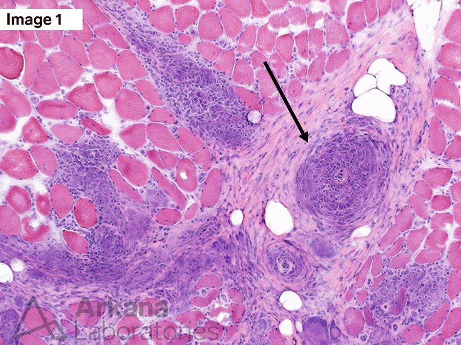 myopathy, Sarcoid Myopathy and Vasculopathy, Neuro Notes, neuropathology, arkana laboratories