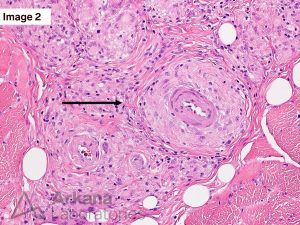 myopathy, Sarcoid Myopathy and Vasculopathy, Neuro Notes, neuropathology, arkana laboratories