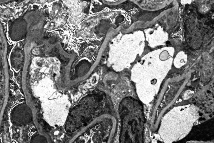 Infection-Associated Glomerulonephritis, diagnose this, arkana laboratories, renal disease of the kidney