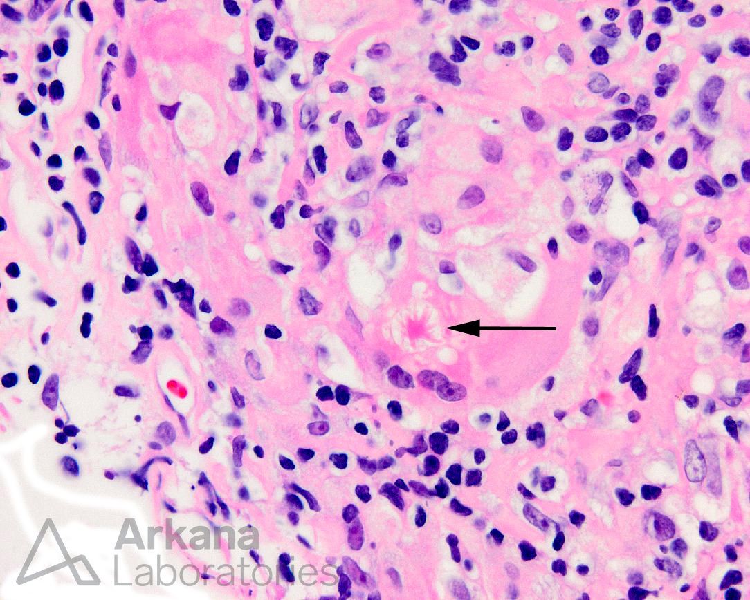 Asteroid Body, Sarcoidosis, renal pathology, arkana laboratories, pathology of the kidney