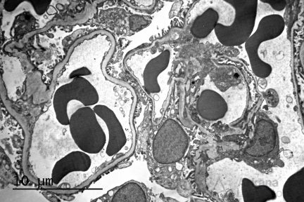 GBM, glomerular basement membranes, diagnose this, arkana laboratories