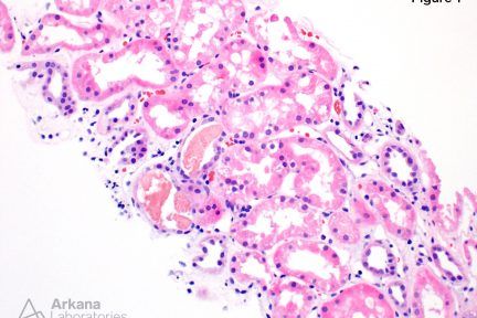 acute tubular injury with numerous pigmented myoglobin casts