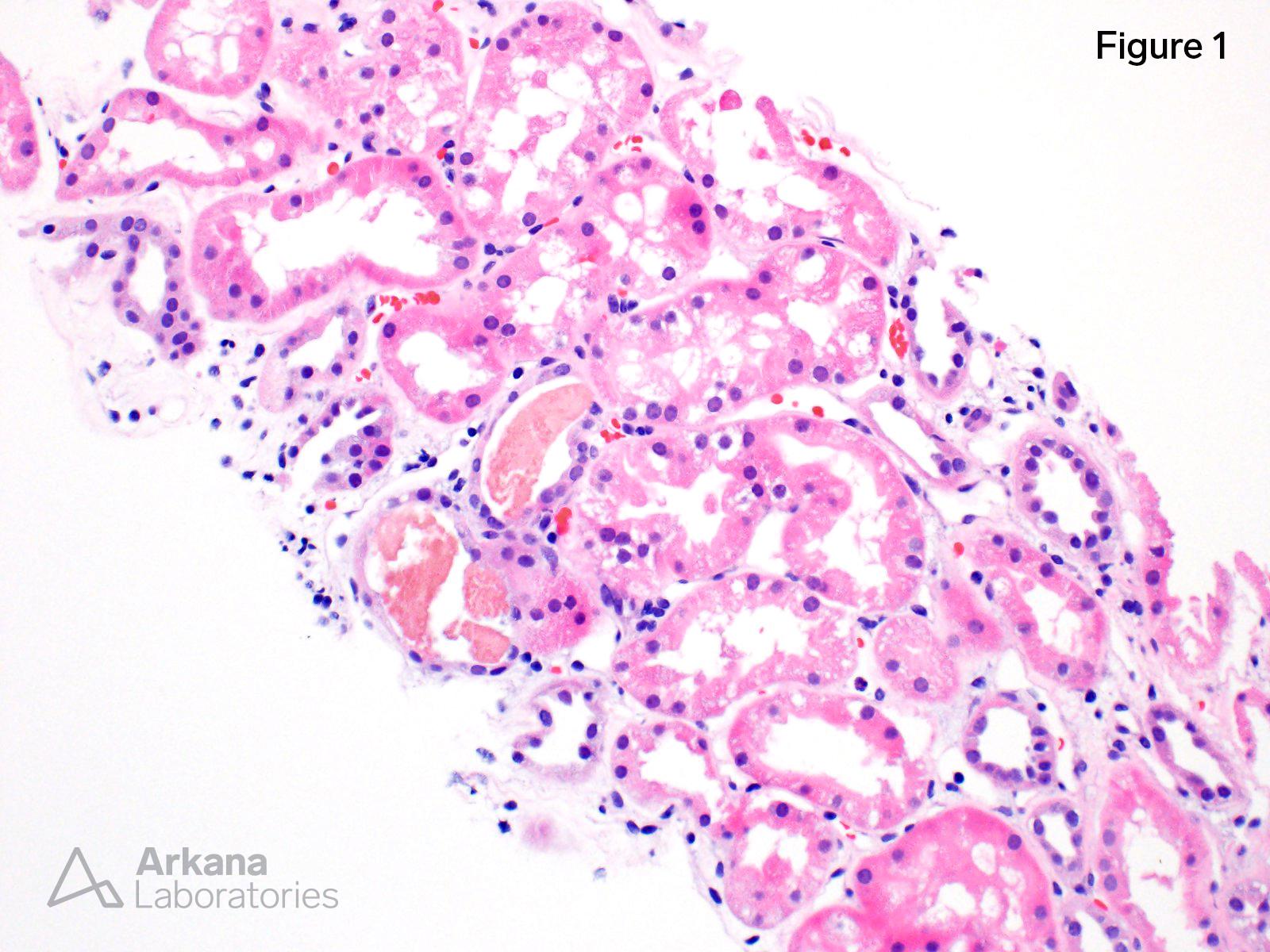 acute tubular injury with numerous pigmented myoglobin casts