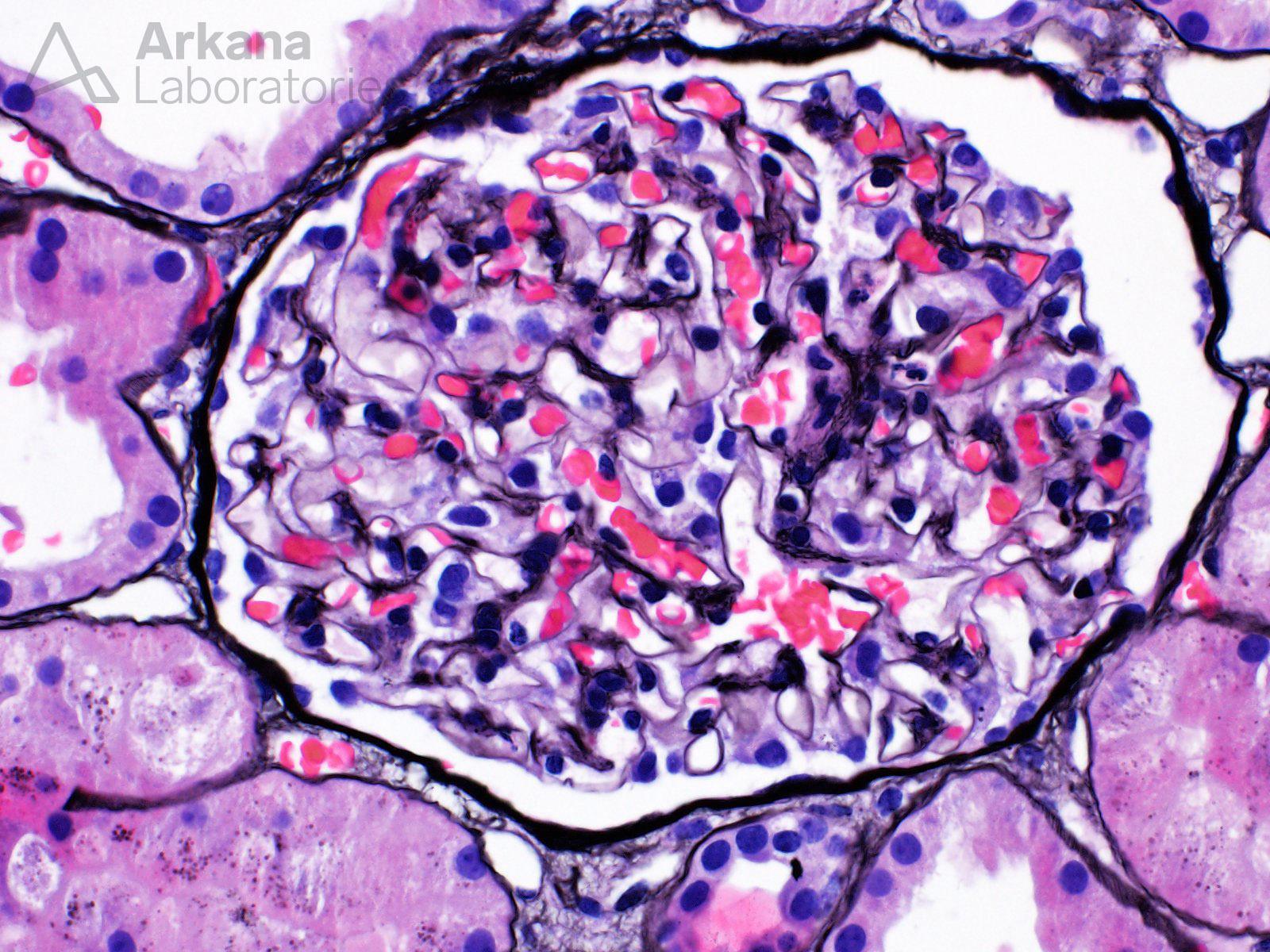 Malpighi Glomerulus, glom in renal biopsy