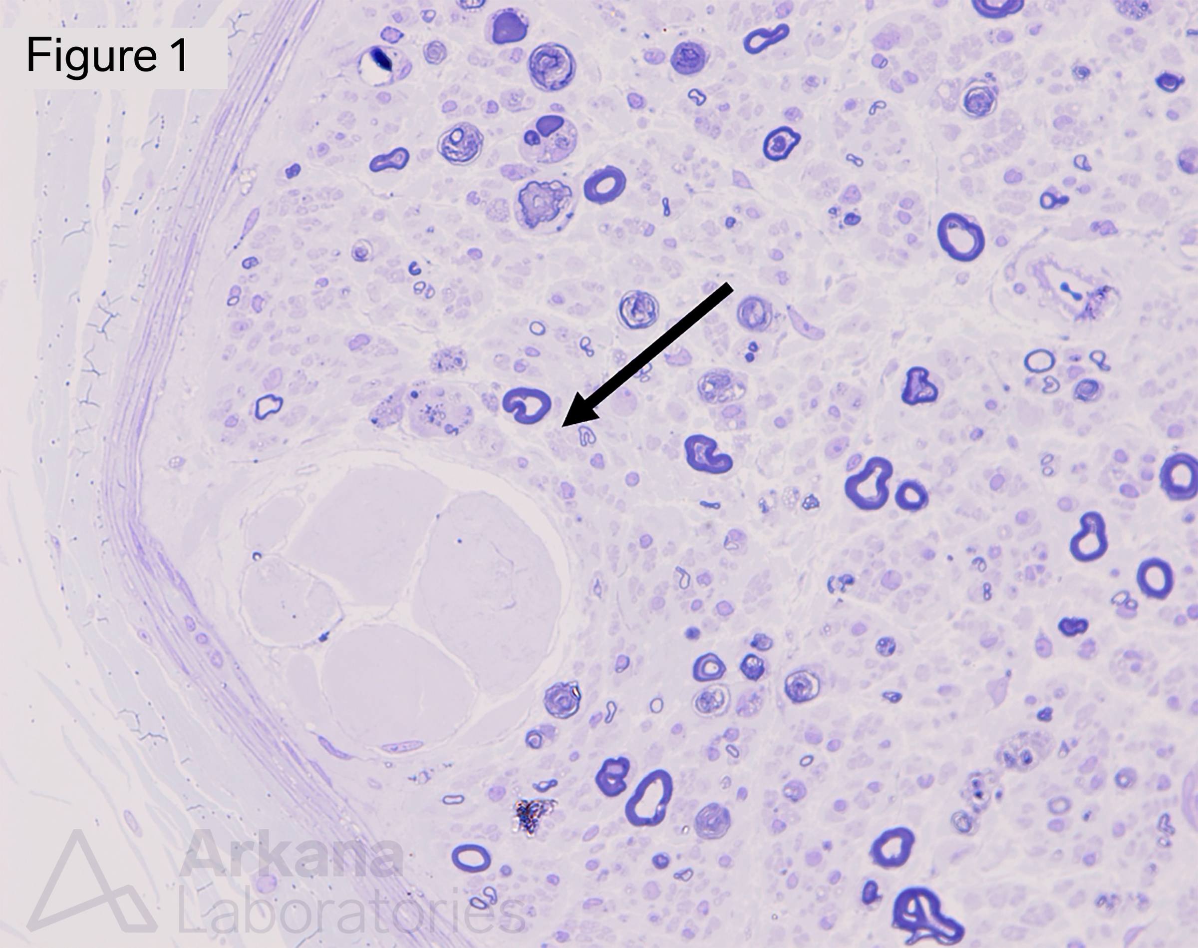 Renaut body, neuro notes, muscle biopsy, neuropathology