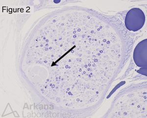 Renaut body, neuro notes, muscle biopsy, neuropathology