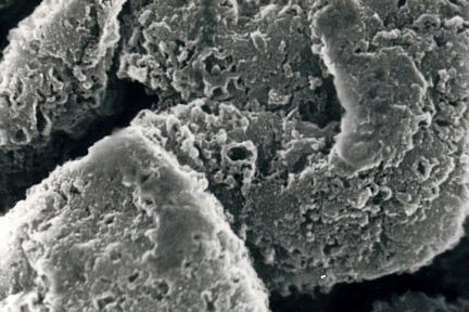 Stage III Membranous Glomerulonephritis, acellular scanning EM, eyescandy, renal pathology