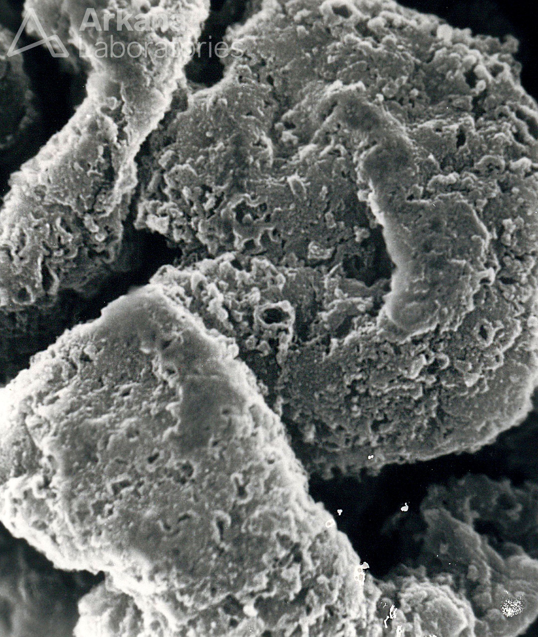 Stage III Membranous Glomerulonephritis, acellular scanning EM, eyescandy, renal pathology