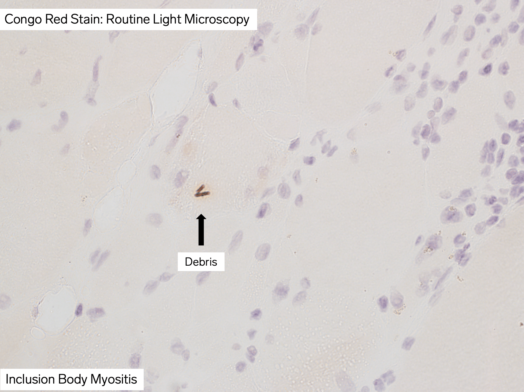 congophilic inclusions, sporadic Inclusion Body Myositis, neuropathology, arkana laboratories, neuro notes