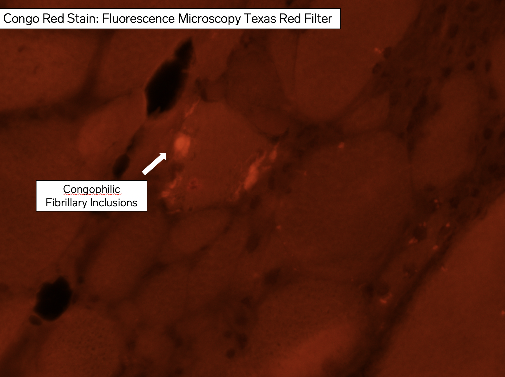 Congophilic Inclusions