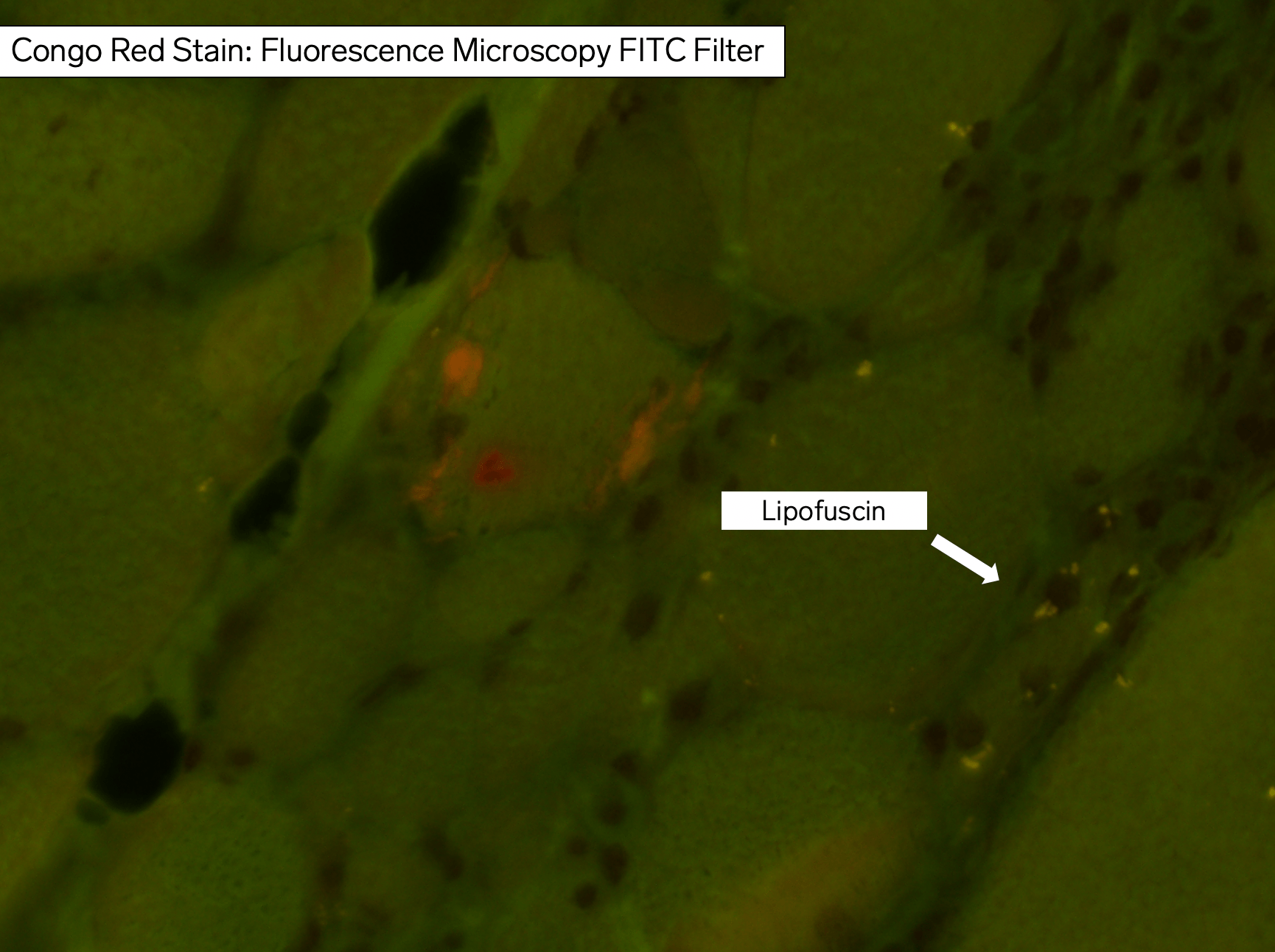 Congophilic Inclusions