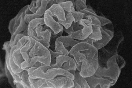 Subpodcocytic Capillary Loop Basement Membranes, renal pathology, electron microscopy