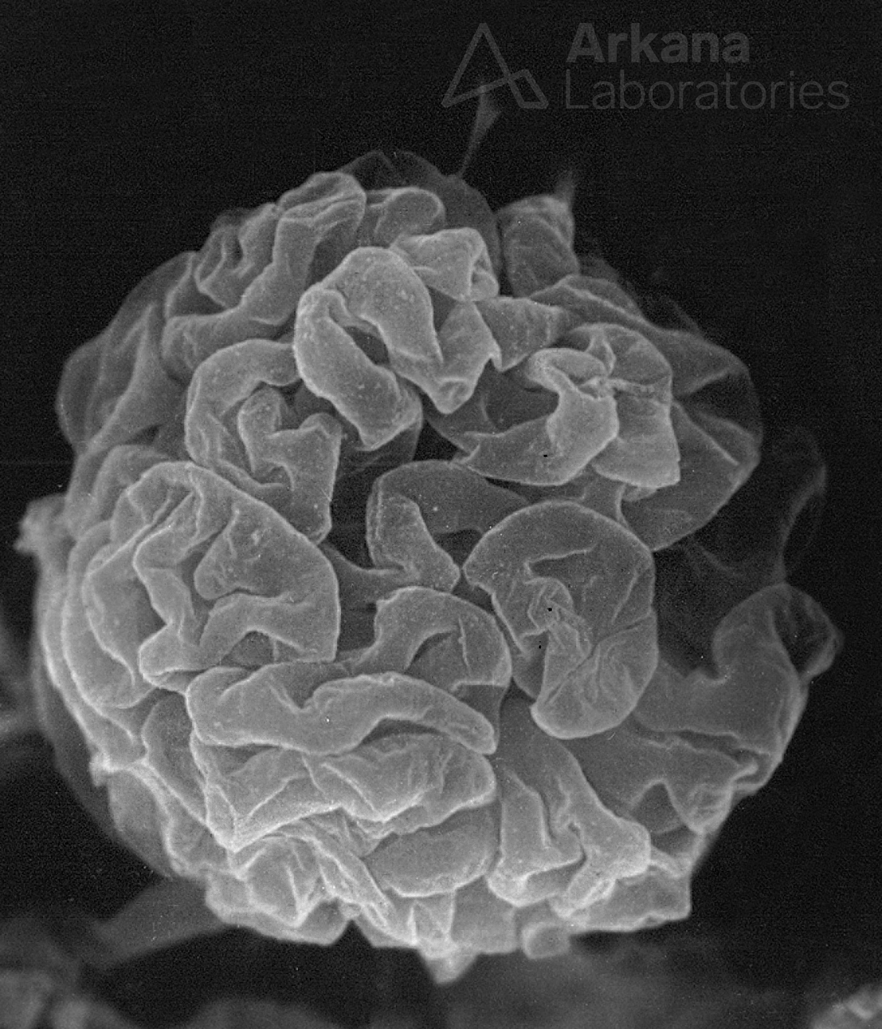 Subpodcocytic Capillary Loop Basement Membranes, renal pathology, electron microscopy