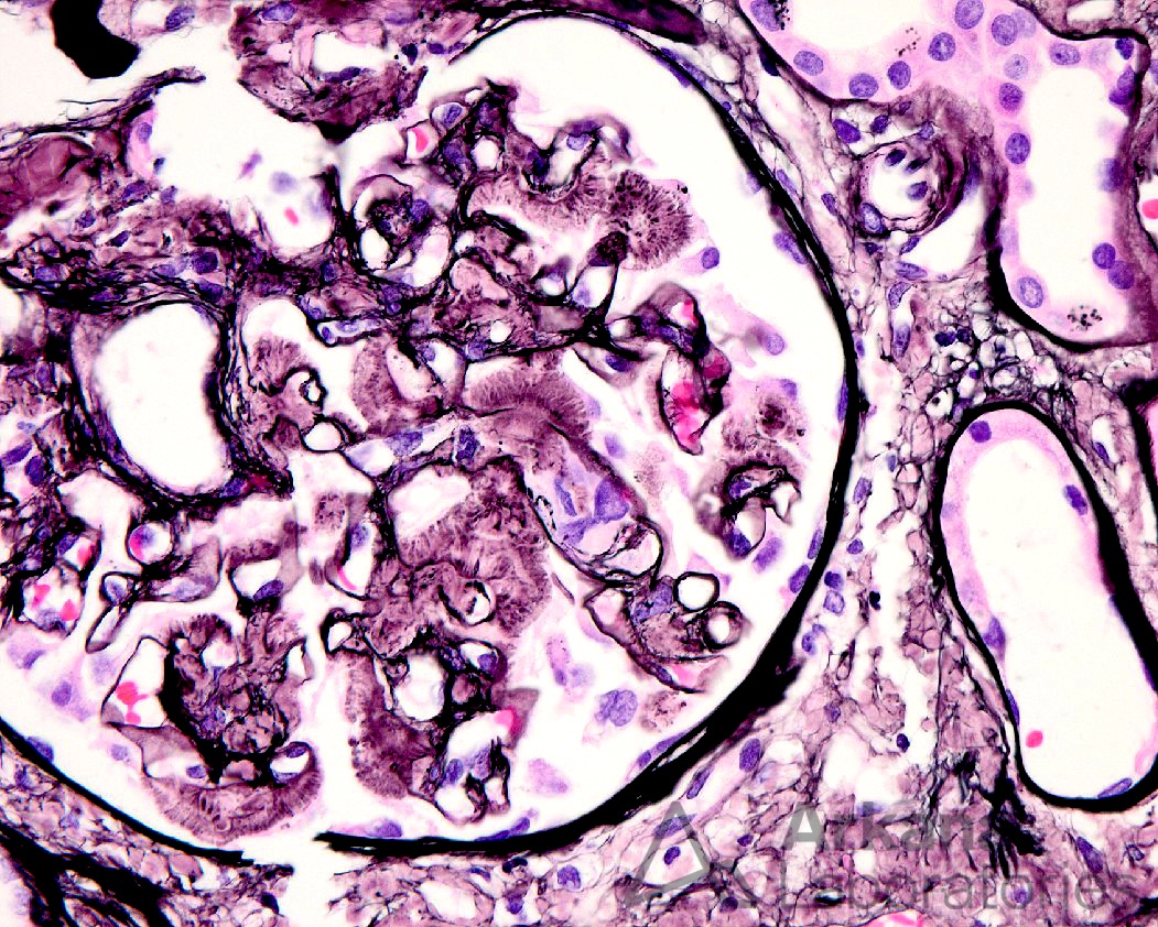 amyloidosis, Amyloid Spicules on Jones Silver Stain, amyloid spicules with eyelashes, renal pathology