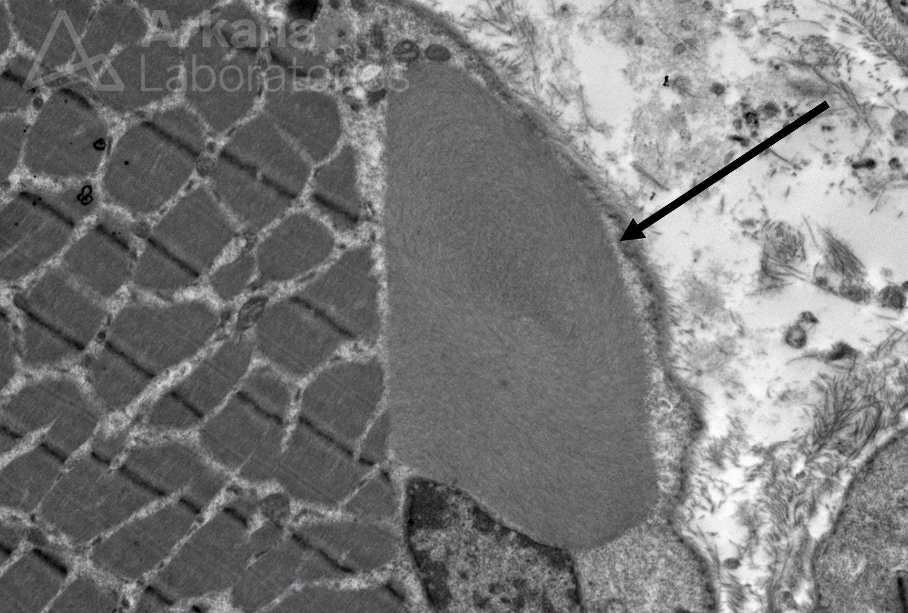 Fibrous Body, neuro path, arkana laboratories, Muscle biopsy