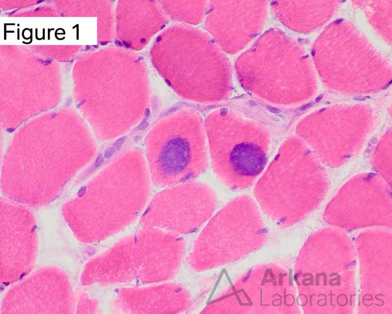 Tubular Aggregate Myopathy (TMA) | Neuro Notes | Arkana Laboratories