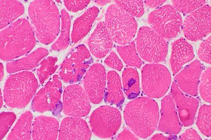 Myopathy with Tubular Aggregates