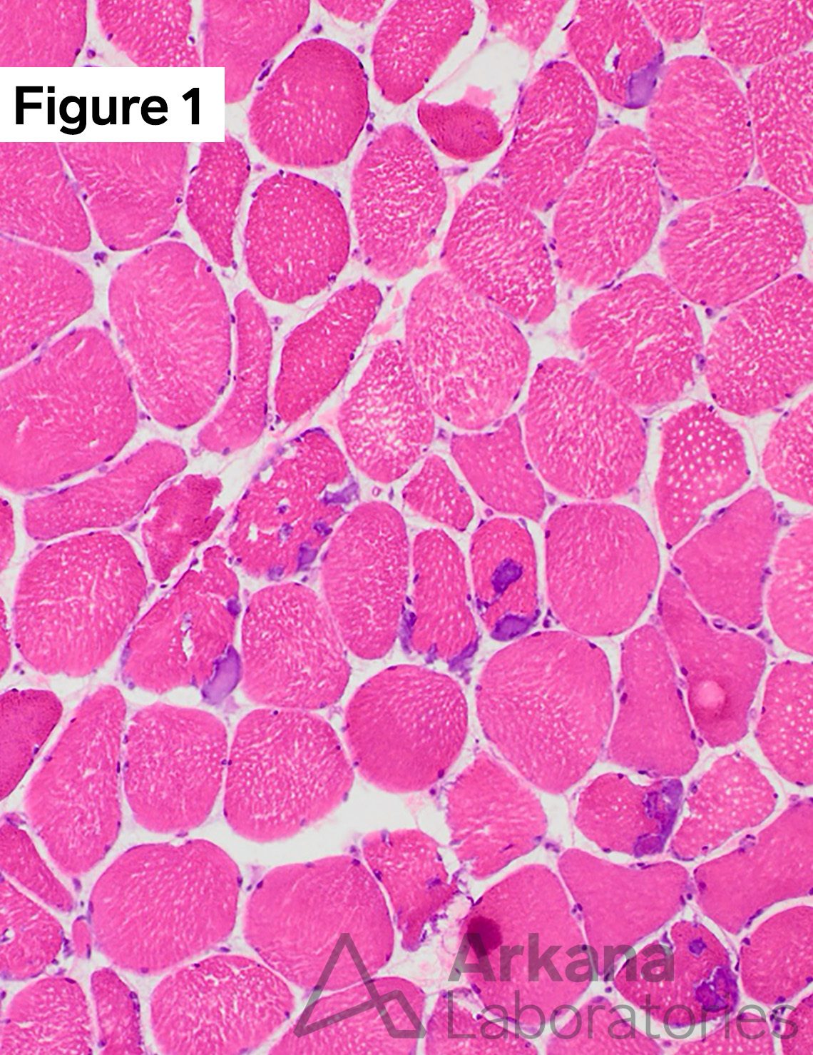 Myopathy with Tubular Aggregates