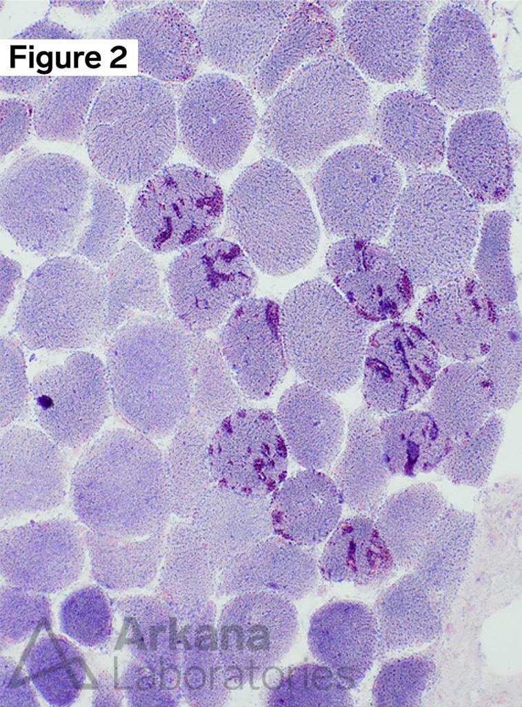 Myopathy with Tubular Aggregates | Neuro Notes | Arkana Laboratories