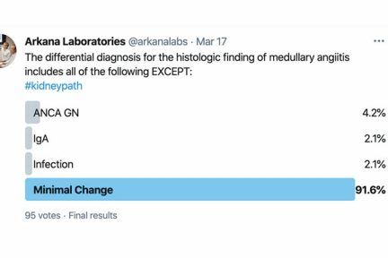 Minimal Change Disease, arkana laboratories, kidney pathology, renal pathology