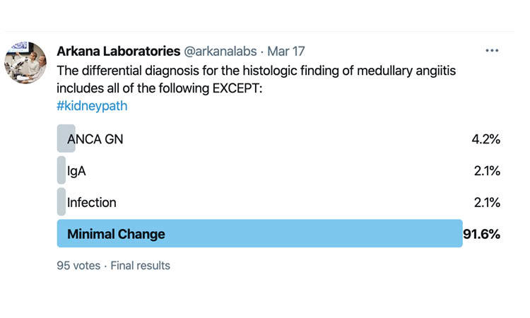 Minimal Change Disease, arkana laboratories, kidney pathology, renal pathology