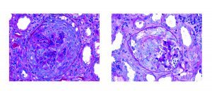 endocarditis-associated GN and ANCA-related glomerulonephritis, renal staining