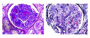 Staphylococcal infections and IgA staining, Disease Week, renal imaging