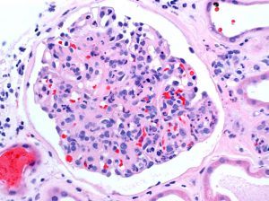 Infection-Associated Glomerulonephritis