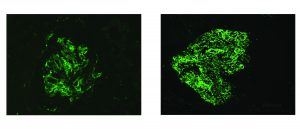 C3 staining, arkana, renal pathology