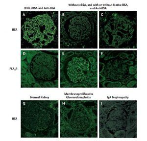 PLA2R renal pathology stain on kidney biopsy