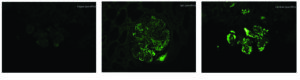 C3 Glomerulonephritis