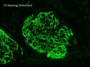 C3 Glomerulonephritis