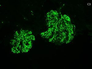 C3 Glomerulonephritis