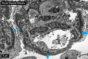 C3 Glomerulonephritis