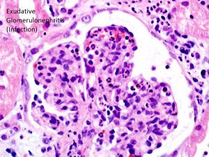 C3 Glomerulonephritis