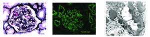 IgG staining, Membranous glomerulopathy