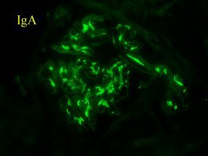 Arkana Laboratories IgA renal biopsy stain, Inflammatory Bowel Disease