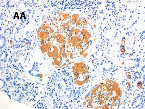 Inflammatory Bowel Disease, renal pathology, renal biopsy stain