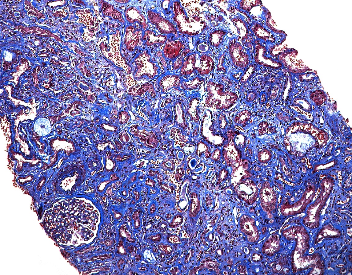 quiz over Tubulointerstitial Diseases for renal pathologists and nephrologists