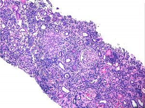 Inflammatory Bowel Disease