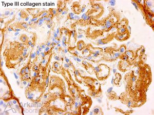 Collagen Type III Glomerulopathy