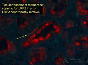 tubular basement membrane staining, Membranous glomerulopathy, renal biopsy