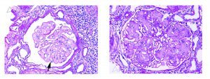 Collagen Type III Glomerulopathy, tubular injury