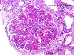 C3 Glomerulonephritis