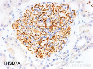 THSD7A staining of glom, kidney pathology, Membranous glomerulopathy