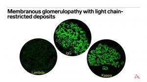 Membranous glomerulopathy with light chain-restricted deposits